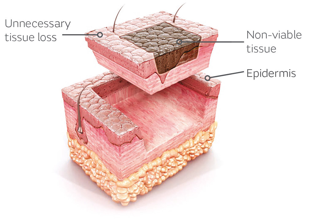 Conventional surgical excision