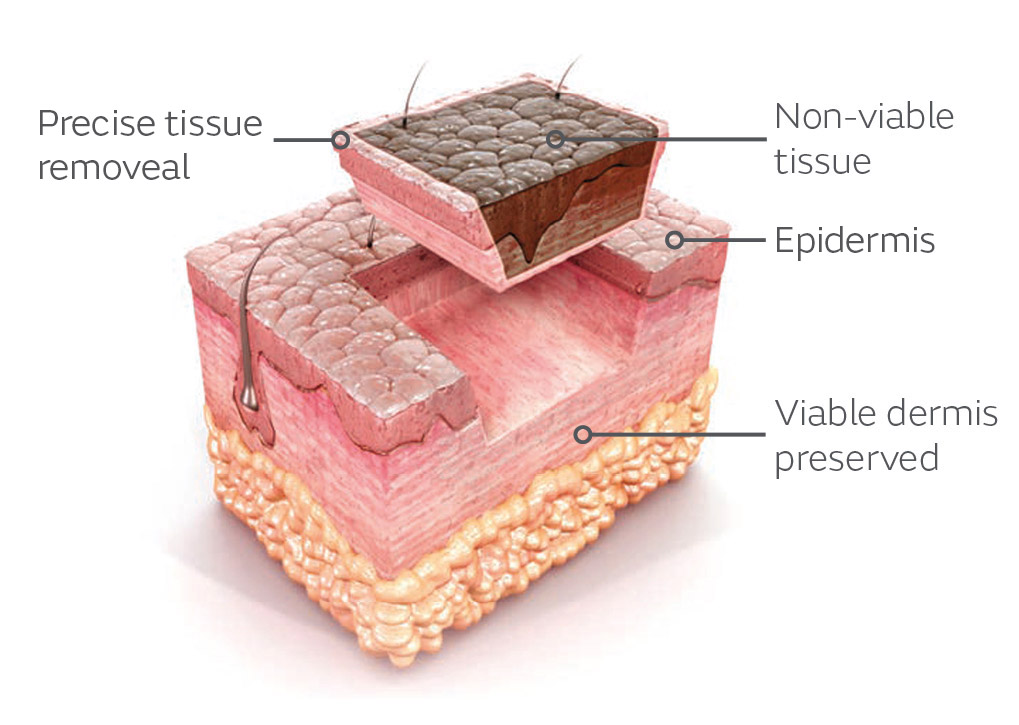 VERSAJET II Excision